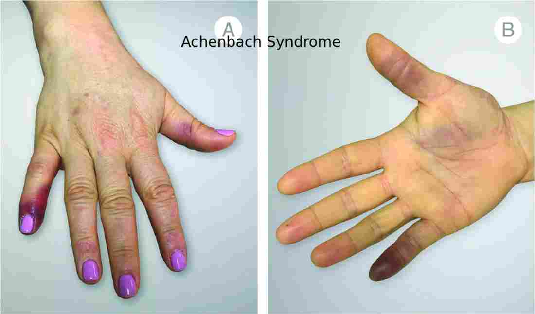 Achenbach Syndrome