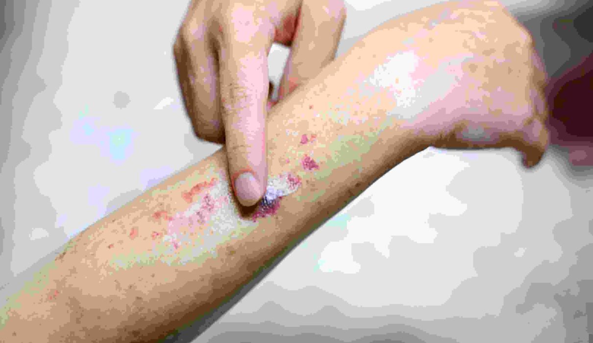 petechiae pictures