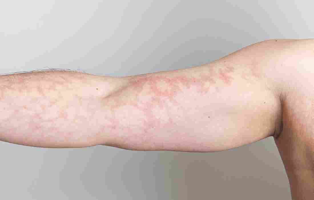 photos of mottled skin